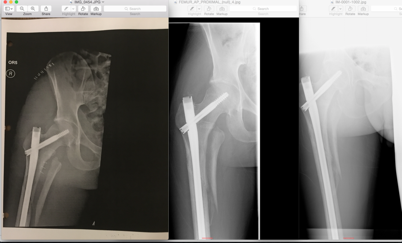 newer x rays of femur