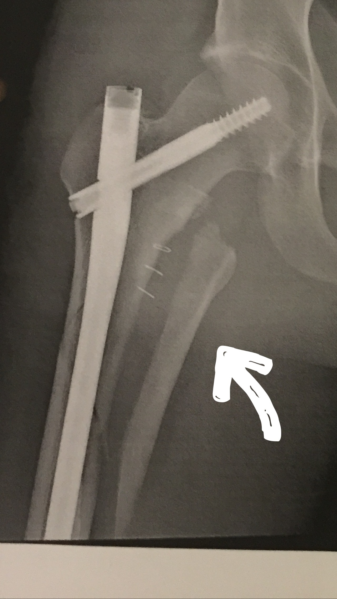 broken femur xray