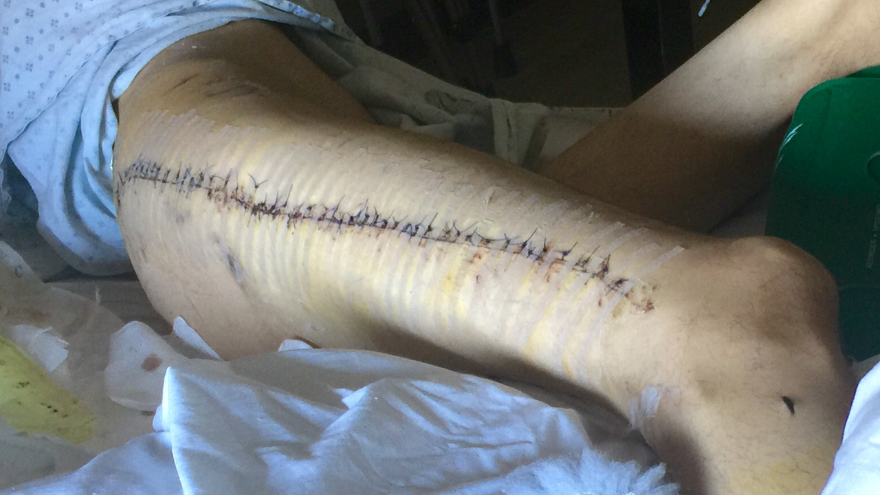 my leg stitched up