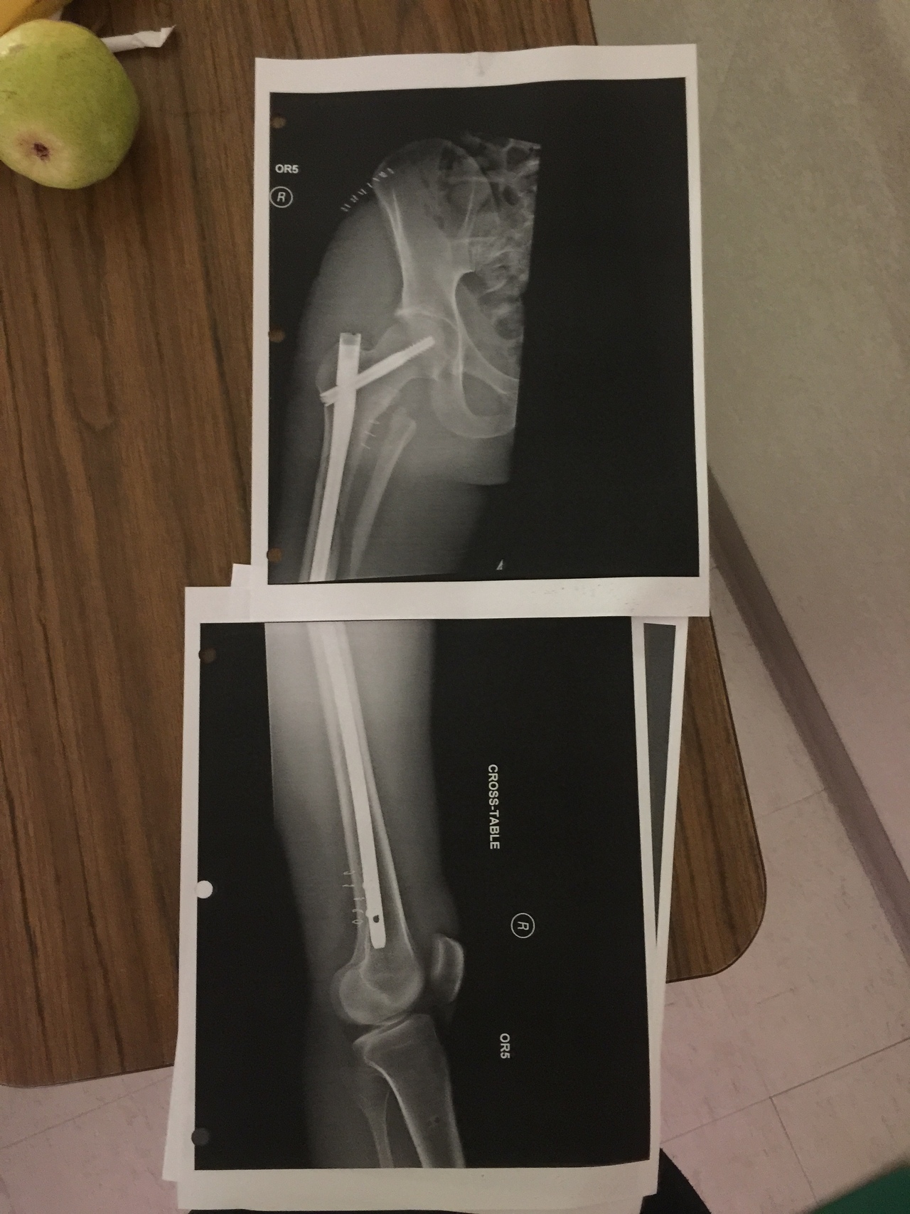 femur ap proximal xray